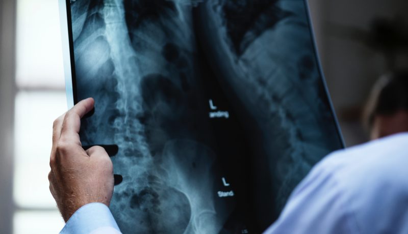 Doctor examines spinal xray